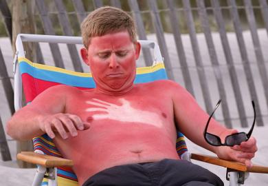 A sunburned man