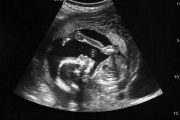 An ultrasound image of a foetus An ultrasound image of a foetus