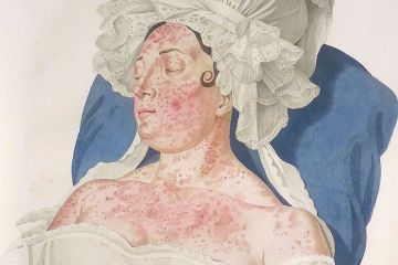 skin disease woman