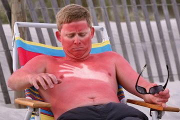 A sunburned man A sunburned man