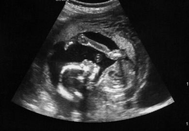An ultrasound image of a foetus